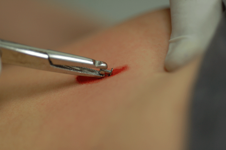 So that's how a dermal is put in!