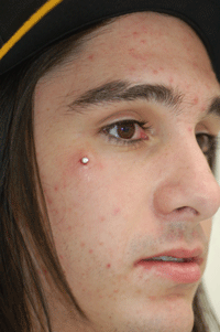 This is a popular area for a dermal